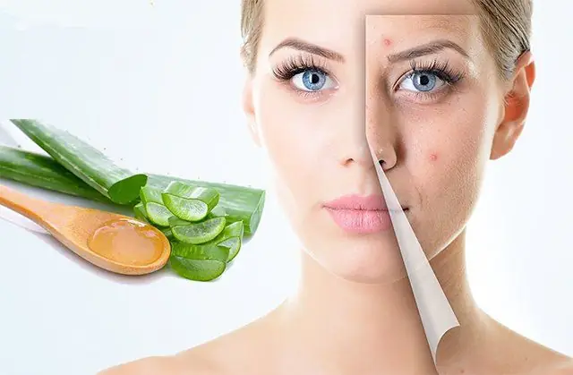 Cách Làm Mặt Nạ Nha Đam Trị Mụn Hiệu Quả Từ A Đến Z
