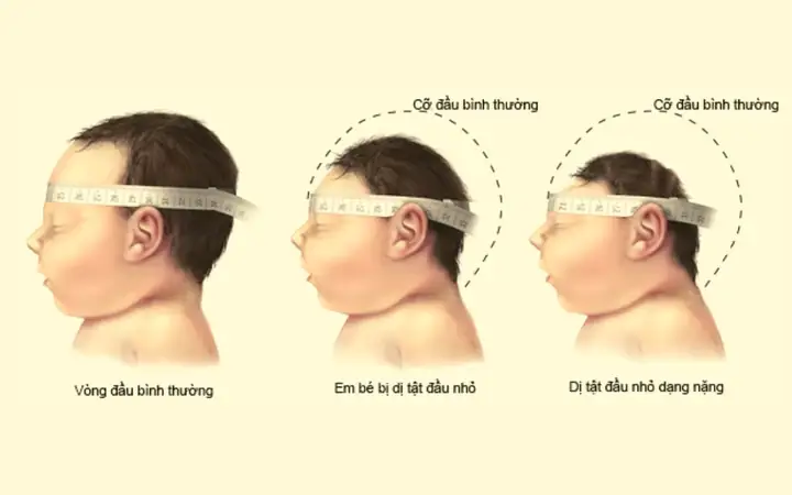 Bảng Đo Vòng Đầu Trẻ Sơ Sinh Bảng Đo Vòng Đầu Trẻ Sơ Sinh