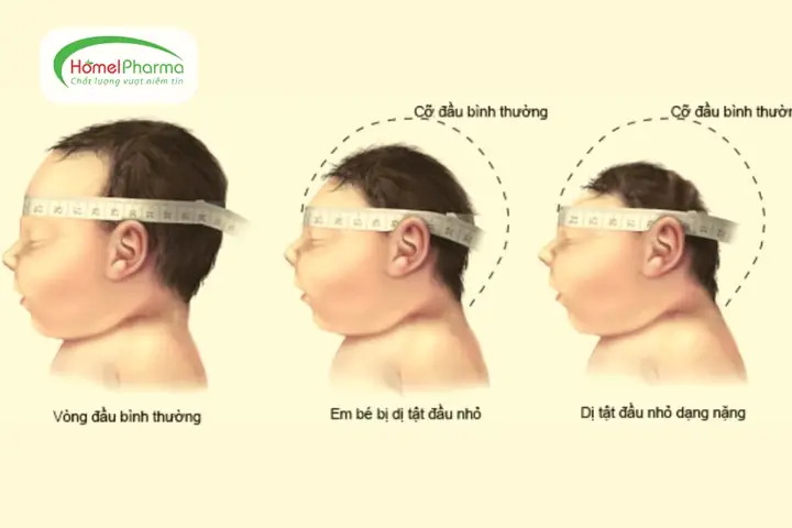 Bảng Đo Vòng Đầu Trẻ Sơ Sinh Bảng Đo Vòng Đầu Trẻ Sơ Sinh
