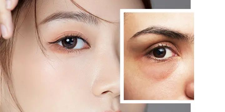 Bọng Mắt To Tướng Số Bọng Mắt To Tướng Số