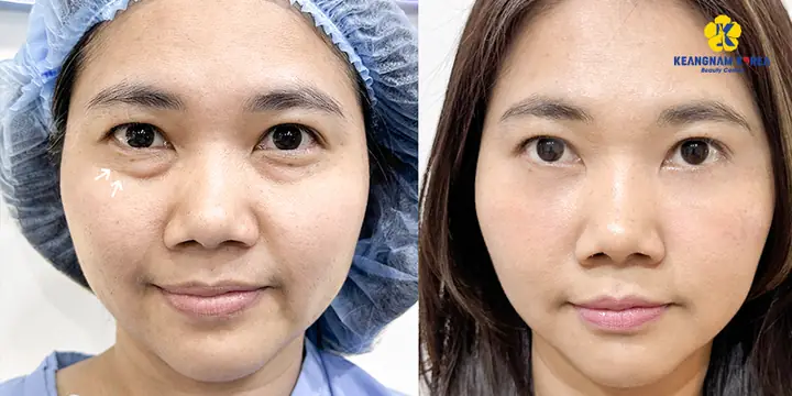 Bọng Mắt To Tướng Số Bọng Mắt To Tướng Số