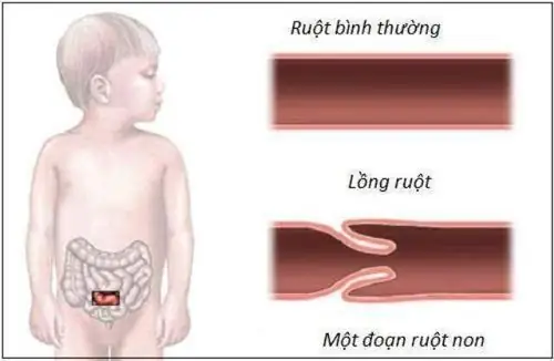 Các Loại Đau Bụng Ở Trẻ Các Loại Đau Bụng Ở Trẻ