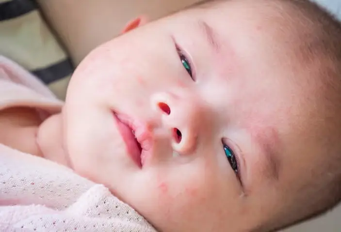 Cách Chữa Bệnh Đau Mắt Ở Trẻ Sơ Sinh Cách Chữa Bệnh Đau Mắt Ở Trẻ Sơ Sinh
