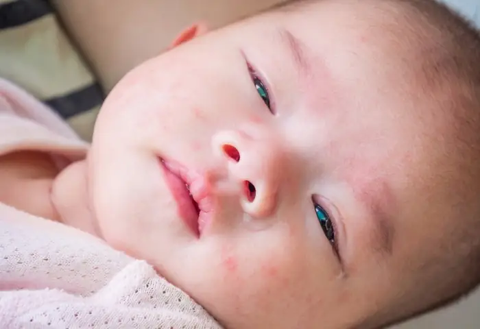 Cách Chữa Bệnh Đau Mắt Ở Trẻ Sơ Sinh Cách Chữa Bệnh Đau Mắt Ở Trẻ Sơ Sinh
