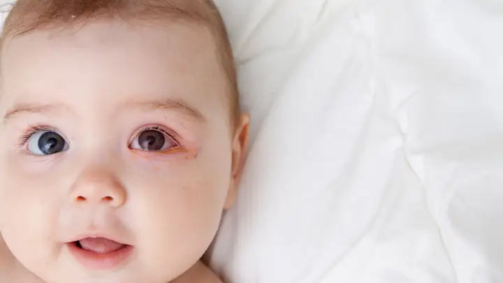 Cách Chữa Bệnh Đau Mắt Ở Trẻ Sơ Sinh Cách Chữa Bệnh Đau Mắt Ở Trẻ Sơ Sinh