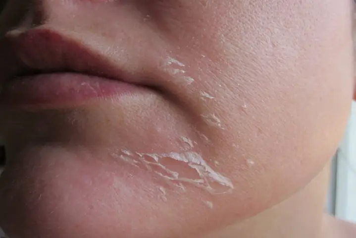 Cách Làm Hết Tróc Da Mặt Cách Làm Hết Tróc Da Mặt