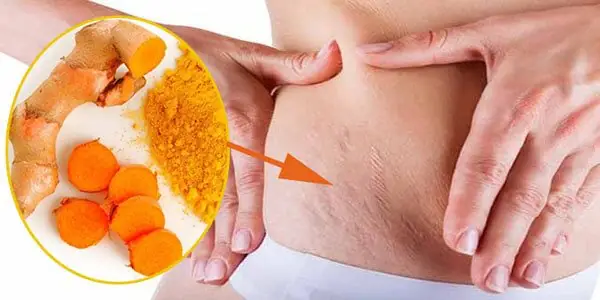 Cách Làm Rượu Nghệ Trị Rạn Da Cách Làm Rượu Nghệ Trị Rạn Da