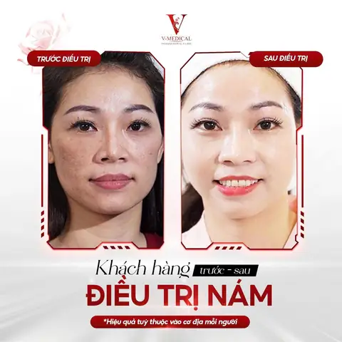 Cách Trị Nám Bằng Quả Gấc Cách Trị Nám Bằng Quả Gấc