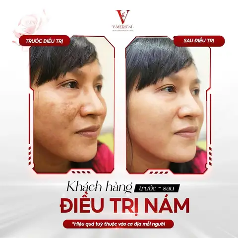 Cách Trị Nám Bằng Quả Gấc Cách Trị Nám Bằng Quả Gấc