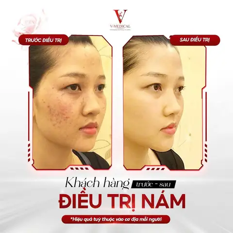 Cách Trị Nám Bằng Quả Gấc Cách Trị Nám Bằng Quả Gấc