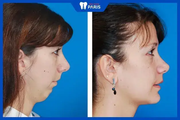 Cằm Ngắn Tướng Số Cằm Ngắn Tướng Số