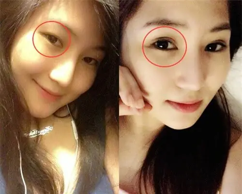 Cắt Mí Mắt Có Ảnh Hưởng Đến Tướng Số Không Cắt Mí Mắt Có Ảnh Hưởng Đến Tướng Số Không