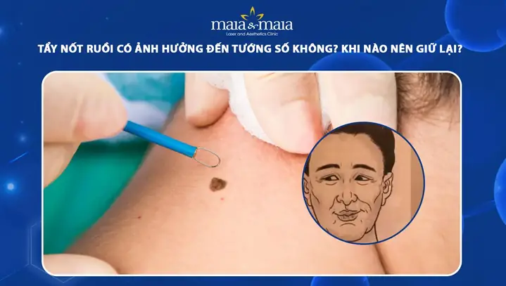 Coi Nốt Ruồi Tướng Số Coi Nốt Ruồi Tướng Số