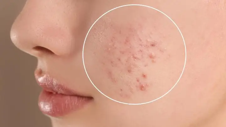 Kem Chống Nắng Gây Mụn Ẩn Kem Chống Nắng Gây Mụn Ẩn