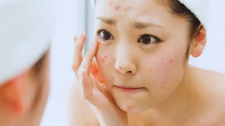 Kem Chống Nắng Gây Mụn Ẩn Kem Chống Nắng Gây Mụn Ẩn