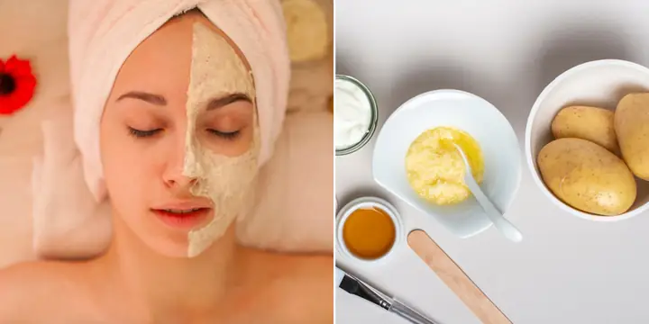Khoai Tây Đắp Mặt Trị Mụn Khoai Tây Đắp Mặt Trị Mụn
