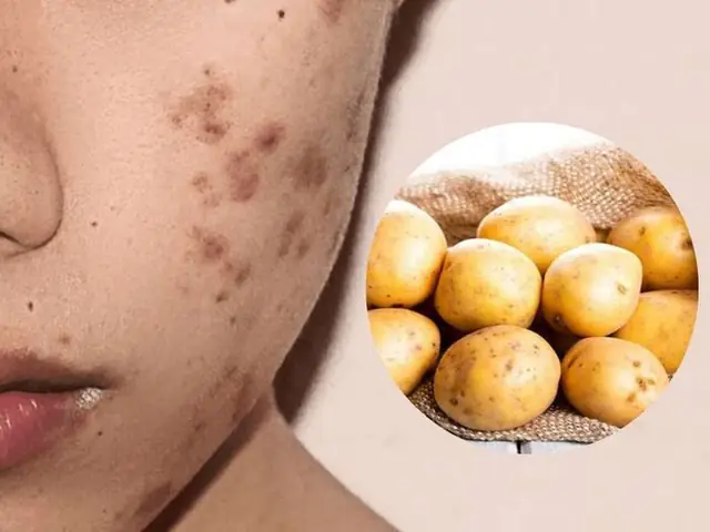 Khoai Tây Đắp Mặt Trị Mụn Khoai Tây Đắp Mặt Trị Mụn
