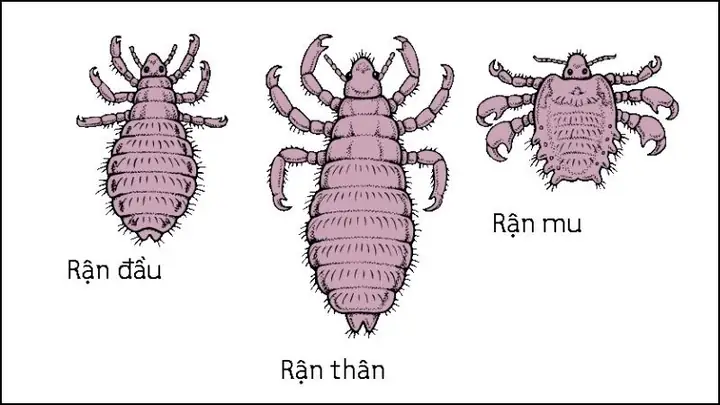 Làm Sao Để Diệt Chấy Trên Tóc