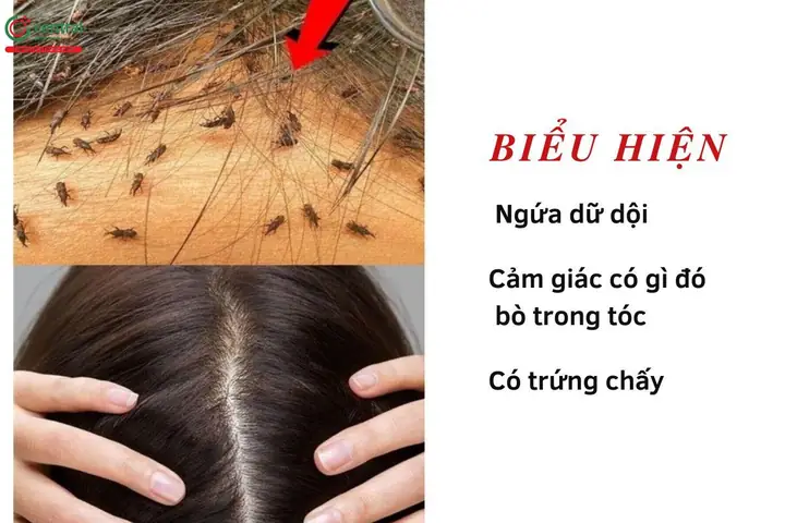 Làm Sao Để Diệt Chấy Trên Tóc