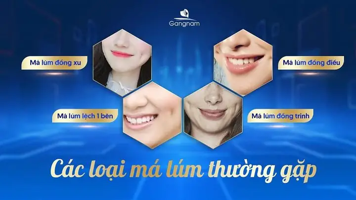 Lúm Đồng Tiền Theo Tướng Số Lúm Đồng Tiền Theo Tướng Số