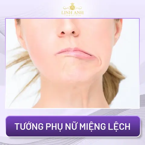Miệng Méo Tướng Số Miệng Méo Tướng Số