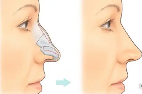 Mũi Gãy Tướng Số Mũi Gãy Tướng Số
