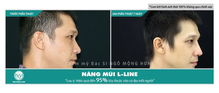 Nâng Mũi Có Thay Đổi Tướng Số Không Nâng Mũi Có Thay Đổi Tướng Số Không