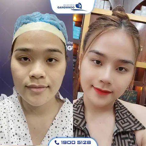 Nâng Mũi Có Thay Đổi Tướng Số Không Nâng Mũi Có Thay Đổi Tướng Số Không
