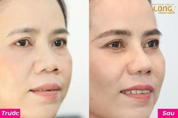 Nâng Mũi Thay Đổi Tướng Số Nâng Mũi Thay Đổi Tướng Số