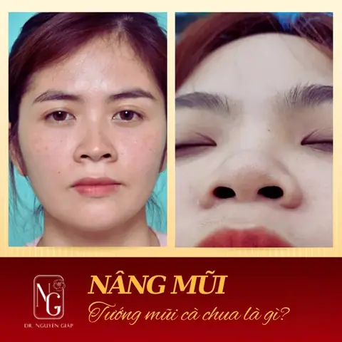 Nâng Mũi Và Tướng Số Nâng Mũi Và Tướng Số