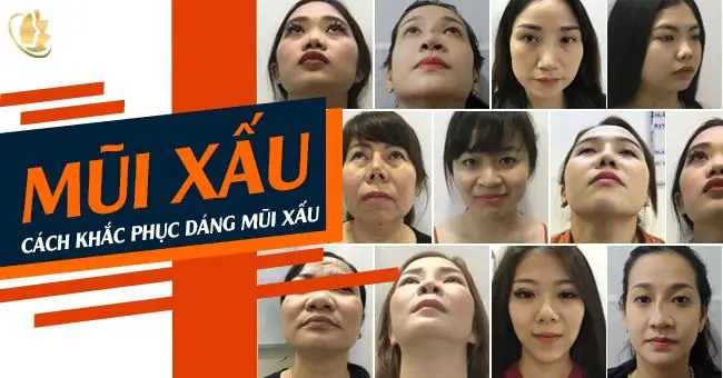 Những Tướng Mũi Xấu Những Tướng Mũi Xấu