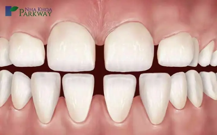Răng Thưa Hàm Trên Tướng Số Răng Thưa Hàm Trên Tướng Số
