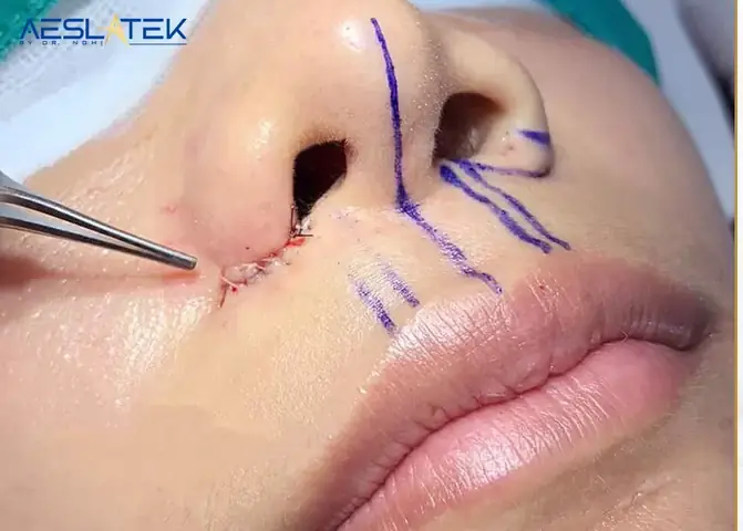 Sẹo Ở Mũi Tướng Số Sẹo Ở Mũi Tướng Số