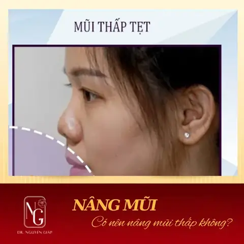 Sống Mũi Thấp Tướng Số Sống Mũi Thấp Tướng Số
