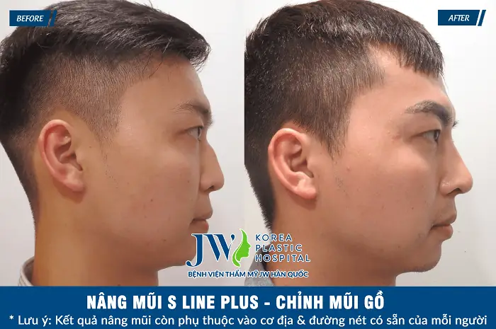 Sửa Mũi Có Ảnh Hưởng Đến Tướng Số
