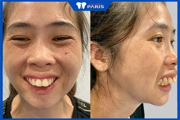Thay Đổi Tướng Số Trên Khuôn Mặt Thay Đổi Tướng Số Trên Khuôn Mặt