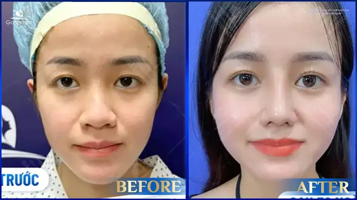 Thế Nào Là Tướng Mũi Xấu Thế Nào Là Tướng Mũi Xấu