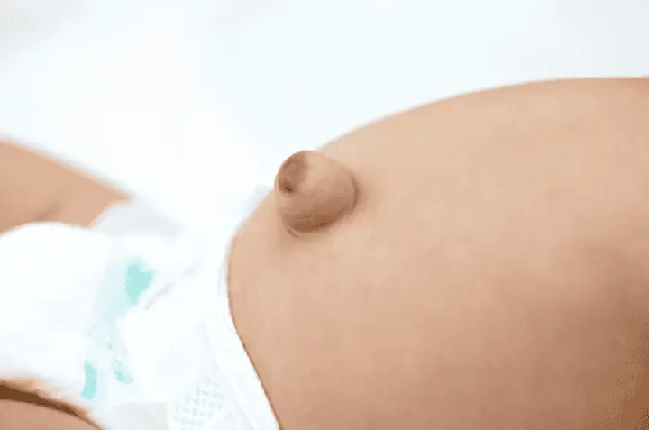 Trẻ Sơ Sinh Bị Lồi Rốn Phải Làm Sao Trẻ Sơ Sinh Bị Lồi Rốn Phải Làm Sao