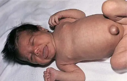 Trẻ Sơ Sinh Bị Lồi Rốn Phải Làm Sao Trẻ Sơ Sinh Bị Lồi Rốn Phải Làm Sao