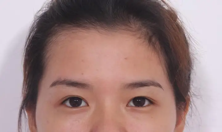 Tướng Mắt 1 Mí Và Mí Lót