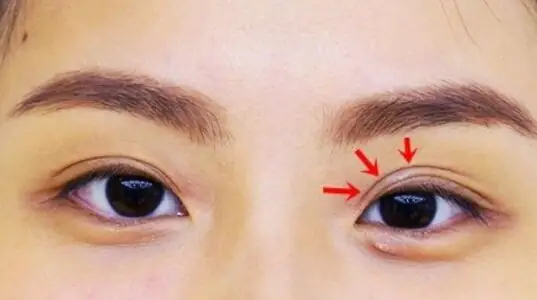 Tướng Mắt 1 Mí Và Mí Lót