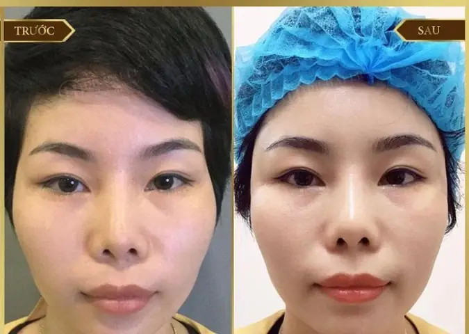 Tướng Mặt Thái Dương Hopa Tướng Mặt Thái Dương Hopa