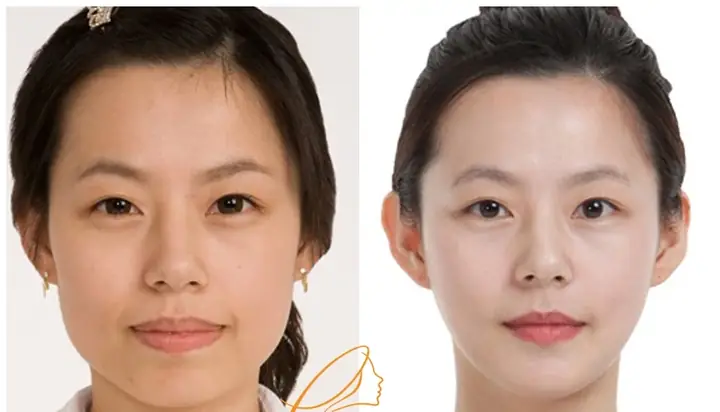 Tướng Mặt Thái Dương Hopa Tướng Mặt Thái Dương Hopa