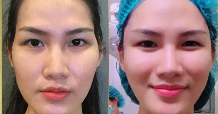Tướng Mặt Thái Dương Hopa Tướng Mặt Thái Dương Hopa