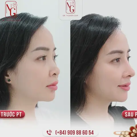 Tướng Mũi Gồ Lên Tướng Mũi Gồ Lên
