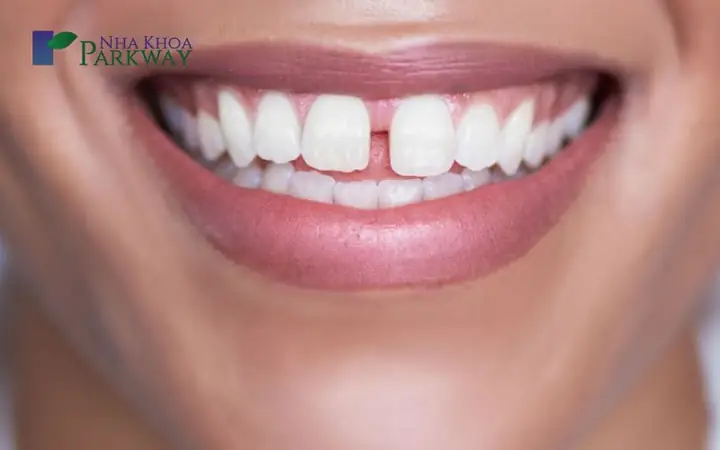 Tướng Răng Cửa Bị Hở Tướng Răng Cửa Bị Hở