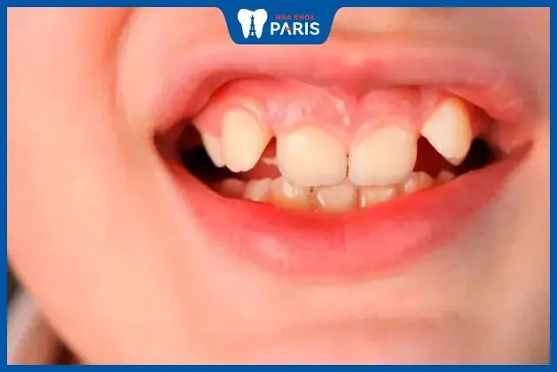 Tướng Răng Cửa Răng Chuột Tướng Răng Cửa Răng Chuột