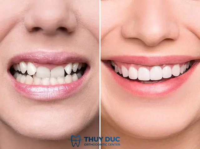 Tướng Răng Hổ Là Như Thế Nào Tướng Răng Hổ Là Như Thế Nào
