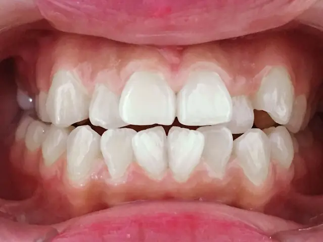 Tướng Răng Khấp Khểnh Tướng Răng Khấp Khểnh