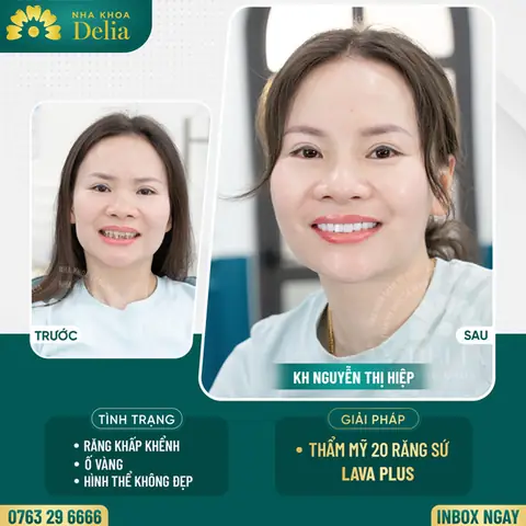 Tướng Răng Khấp Khểnh Tướng Răng Khấp Khểnh